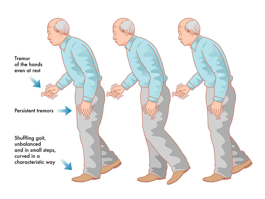 Early Signs of Parkinson’s Disease