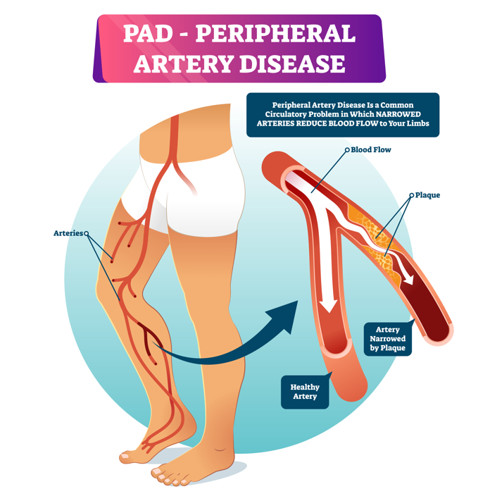 An illustration depicting Peripheral Artery Disease (PAD)