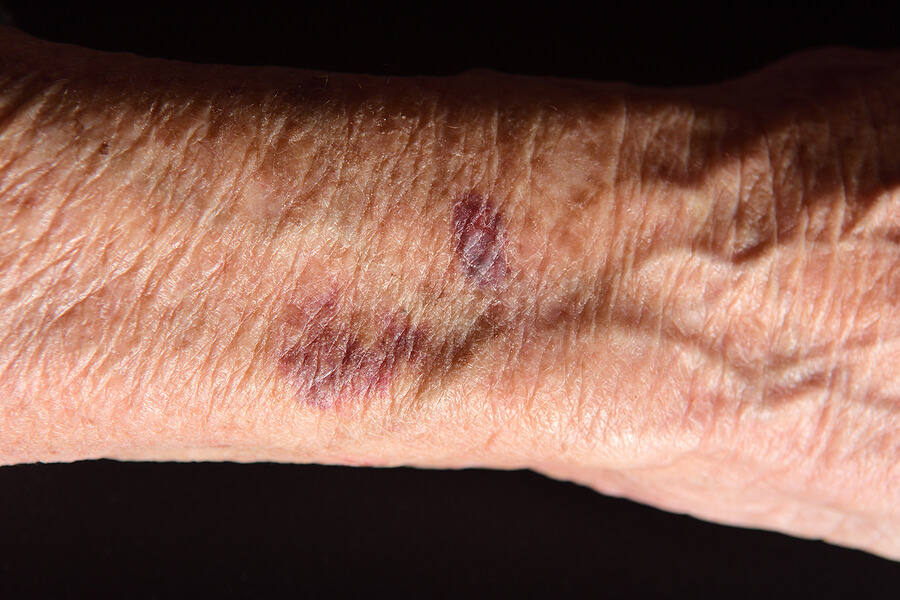 Bruising in the Elderly: What Causes Skin Bruising in Seniors?