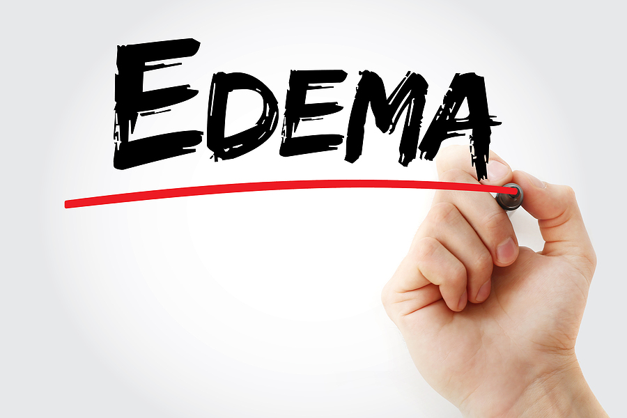 Edema in Elderly Adults: Swollen Legs, Ankles, and Feet