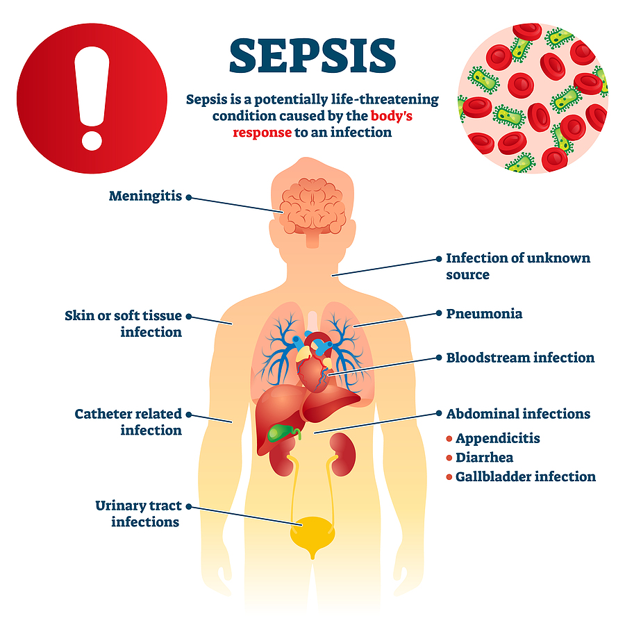 Sepsis in Elderly Adults: What To Know