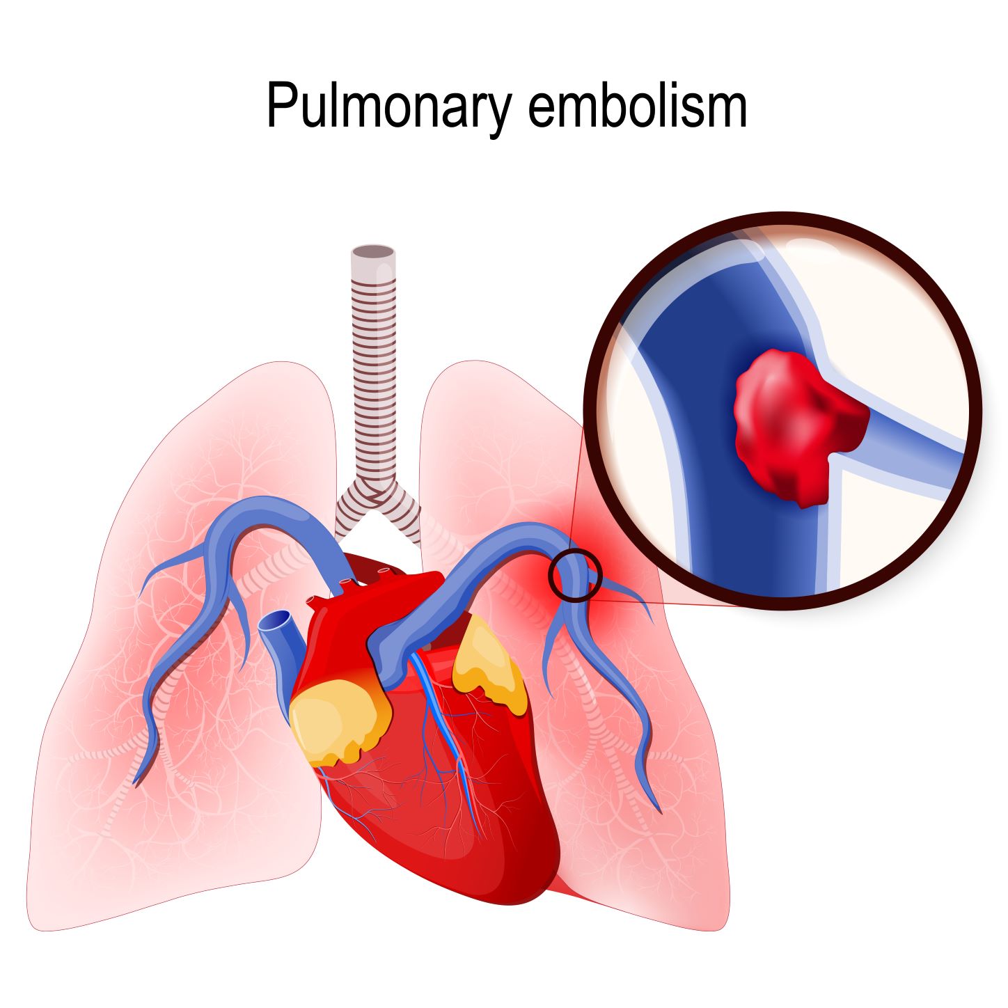 Pulmonary Embolism in Elderly Adults: What To Know