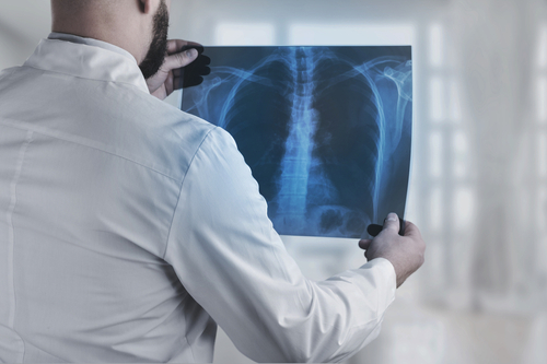 A person in a white lab coat, holds and examines a chest X-ray image.