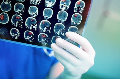 A medical professional, specializing in home health care services, holds and examines a series of brain scan images showing various sections and red highlighted areas.